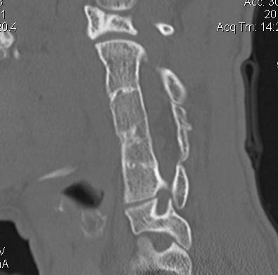 Klippel Feil CT Sagittal